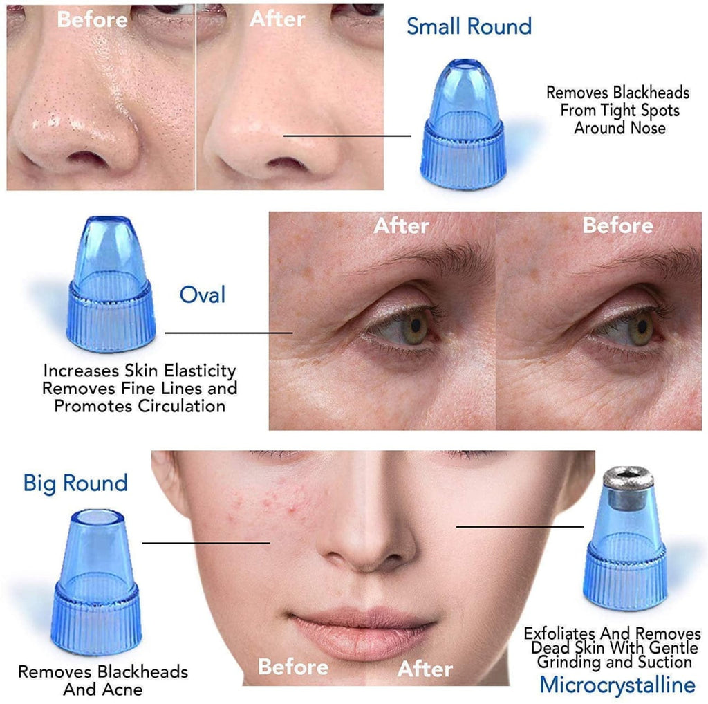 Derma Suction Blackhead Remover Vacuum Suck The Yuck Out Of Your Pores (cell Operated)